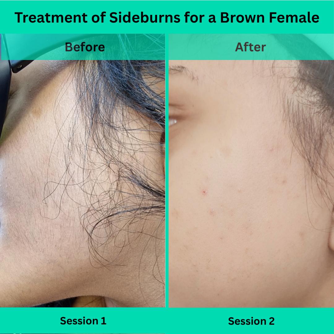 Before and After picture of Laser Hair Removal Treatment of Sideburns for a Female